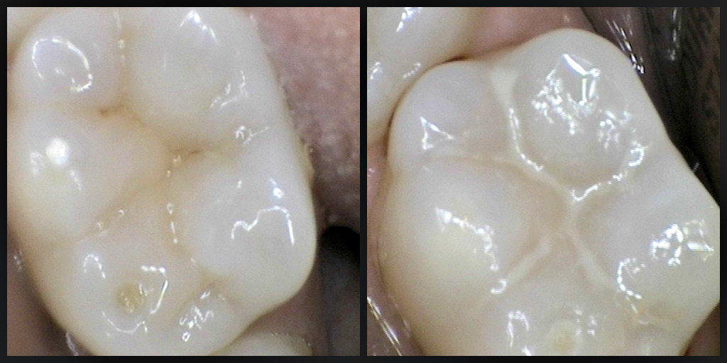 sealant on a tooth