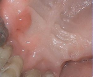 Gum tissue lesion on roof of mouth.