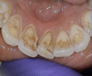 Staining behind front teeth.