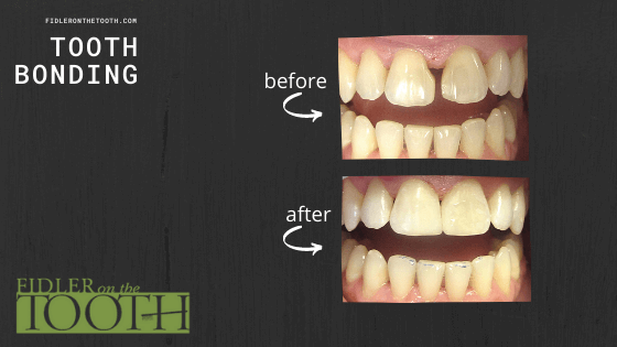 Before and after results with dental bonding
