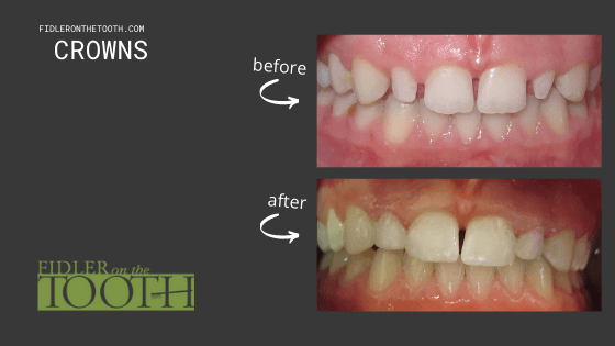 Before and after results with dental crowns